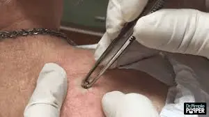 REMOVING GIANT BLACKHEADS